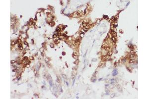 Anti-PGK1 antibody, IHC(P) IHC(P): Human Lung Cancer Tissue (PGK1 抗体  (Middle Region))