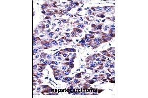 DUSP9 Antibody (C-term) ((ABIN657812 and ABIN2846780))immunohistochemistry analysis in formalin fixed and paraffin embedded human hepatocarcinoma followed by peroxidase conjugation of the secondary antibody and DAB staining. (DUSP9 抗体  (C-Term))