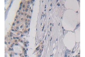 Detection of IL5 in Human Breast cancer Tissue using Polyclonal Antibody to Interleukin 5 (IL5) (IL-5 抗体  (AA 20-134))