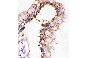 Immunohistochemistry (Paraffin-embedded Sections) (IHC (p)) image for anti-Cadherin 1, Type 1, E-Cadherin (Epithelial) (CDH1) antibody (ABIN4907330)