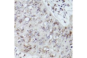 Immunohistochemistry of paraffin-embedded human esophageal cancer using GOLGB1 Rabbit pAb (ABIN7267498) at dilution of 1:100 (40x lens). (Golgin B1 (GOLGB1) 抗体)