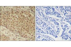 Immunohistochemical analysis of paraffin-embedded human breast carcinoma tissue using Smad2 (Ab-220) Antibody (E021323). (SMAD2 抗体)