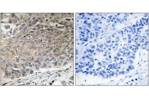 Immunohistochemistry analysis of paraffin-embedded human lung carcinoma tissue, using DYNLL2 Antibody. (DYNLL2 抗体  (AA 1-50))