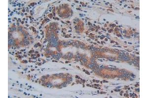 Detection of ITGb3 in Human Stomach cancer Tissue using Polyclonal Antibody to Integrin Beta 3 (ITGb3) (Integrin beta 3 抗体  (AA 135-377))