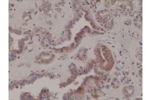 IHC testing of formalin fixed and paraffin embedded human thyroid cancer tissue with recombinant phospho-EIF2A antibody at 1:200 dilution. (Recombinant EIF2A 抗体  (pSer51))