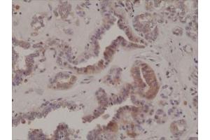 IHC testing of formalin fixed and paraffin embedded human thyroid cancer tissue with recombinant phospho-EIF2A antibody at 1:200 dilution.
