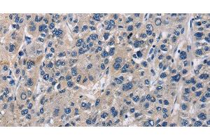 Immunohistochemistry of paraffin-embedded Human liver cancer tissue using ABI3BP Polyclonal Antibody at dilution 1:60 (ABI3BP 抗体)