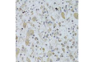Immunohistochemistry of paraffin-embedded human liver cancer using MAP2K5 Antibody. (MAP2K5 抗体  (AA 1-190))