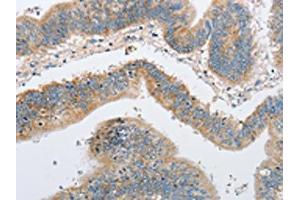 The image on the left is immunohistochemistry of paraffin-embedded Human colon cancer tissue using ABIN7128507(ARHGEF9 Antibody) at dilution 1/50, on the right is treated with fusion protein. (Arhgef9 抗体)