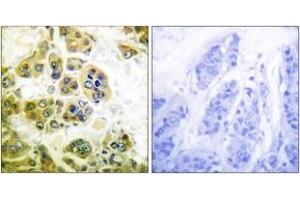Immunohistochemistry analysis of paraffin-embedded human breast carcinoma tissue, using IKK-alpha/beta (Ab-180/181) Antibody. (IKK-alpha /IKK-beta 抗体  (AA 141-190))