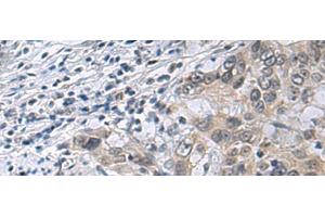 Immunohistochemistry of paraffin-embedded Human esophagus cancer tissue using IRS4 Polyclonal Antibody at dilution of 1:45(x200) (IRS4 抗体)