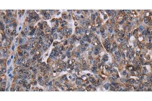 Immunohistochemistry of paraffin-embedded Human ovarian cancer tissue using LDOC1 Polyclonal Antibody at dilution 1:50 (LDOC1 抗体)