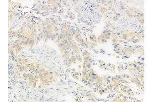 ABIN6259250 and ABIN6276143 at 1/100 staining human lung squamous cell carcinoma by IHC-P.