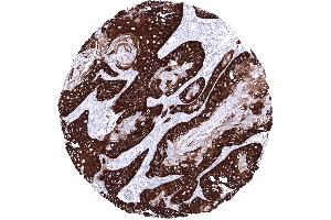 Squamous cell carcinoma of the esophagus with strong predominantly basal KRT14 immunostaining (Recombinant KRT14 抗体  (AA 350-472))