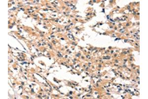 The image on the left is immunohistochemistry of paraffin-embedded Human thyroid cancer tissue using ABIN7190422(CYP46A1 Antibody) at dilution 1/15, on the right is treated with synthetic peptide. (CYP46A1 抗体)