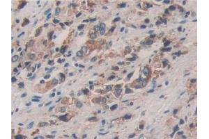 Detection of PDIA4 in Human Prostate cancer Tissue using Polyclonal Antibody to Protein Disulfide Isomerase A4 (PDIA4) (PDIA4 抗体  (AA 505-636))