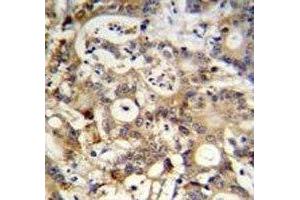 SP1 antibody immunohistochemistry analysis in formalin fixed and paraffin embedded human colon carcinoma. (SP1 抗体  (AA 677-707))
