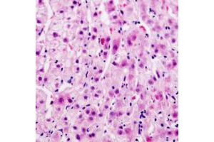Immunohistochemical analysis of Connexin 32 staining in human liver cancer formalin fixed paraffin embedded tissue section. (GJB1 抗体  (Center))