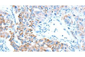 Immunohistochemistry of paraffin-embedded Human lung cancer tissue using ALDH5A1 Polyclonal Antibody at dilution 1:60 (ALDH5A1 抗体)