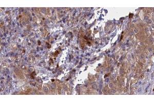 ABIN6277051 at 1/100 staining Human liver cancer tissue by IHC-P. (CD33 抗体  (C-Term))