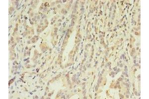 Immunohistochemistry of paraffin-embedded human lung cancer using ABIN7152867 at dilution of 1:100 (FGL2 抗体  (AA 24-439))