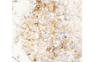 Immunohistochemistry analysis of paraffin-embedded human endometrial cancer using INSR (ABIN7074298) at dilution of 1: 6000 (ISR-alpha 抗体)