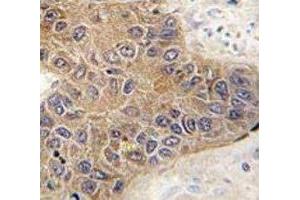 IHC analysis of FFPE human hepatocarcinoma tissue stained with STUB1 antibody (STUB1 抗体  (AA 203-231))