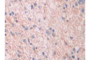 Detection of SAP in Human Glioma Tissue using Polyclonal Antibody to Serum Amyloid P Component (SAP) (APCS 抗体  (AA 23-223))