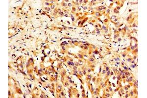 IHC image of ABIN7171484 diluted at 1:400 and staining in paraffin-embedded human liver cancer performed on a Leica BondTM system. (TLN1 抗体  (AA 92-399))
