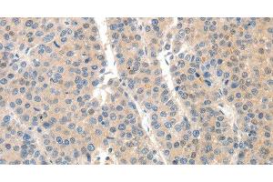 Immunohistochemistry of paraffin-embedded Human liver cancer tissue using SLC20A1 Polyclonal Antibody at dilution 1:40 (SLC20A1 抗体)