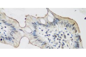 Immunohistochemistry of paraffin-embedded Human stomach cancer using ALOX15 Polyclonal Antibody at dilution of 1:200 (40x lens). (ALOX15 抗体)