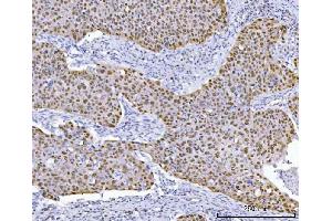 IHC analysis of TP53 using anti-TP53 antibody (ABIN7599050). (p53 抗体  (AA 1-186))
