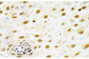 Immunohistochemistry of paraffin-embedded Human esophageal cancer using RUNX1 Polyclonal Antibody at dilution of 1:100 (40x lens). (RUNX1 抗体)