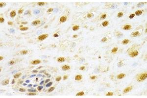 Immunohistochemistry of paraffin-embedded Human esophageal cancer using RUNX1 Polyclonal Antibody at dilution of 1:100 (40x lens).