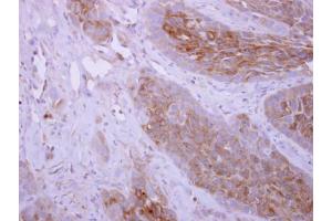 IHC-P Image DPYD antibody [N1N2], N-term detects DPYD protein at cytoplasm on H358 xenograft by immunohistochemical analysis. (DPYD 抗体)