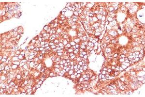 Immunohistochemistry of paraffin-embedded Human colon carcinoma using FAM98A Polyclonal Antibody at dilution of 1:100 (40x lens). (FAM98A 抗体)