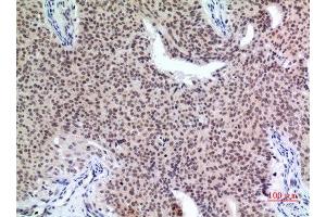 Immunohistochemistry (IHC) analysis of paraffin-embedded Human Mammary Cancer, antibody was diluted at 1:100. (P57 (Ser24) 抗体)