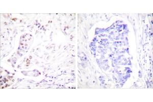 Peptide - +Immunohistochemical analysis of paraffin-embedded human breast carcinoma tissue using Cyclin A1 antibody (#C0166). (Cyclin A1 抗体)