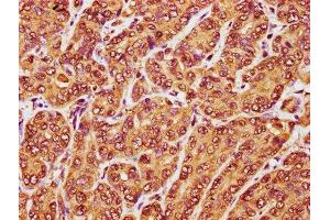 IHC image of ABIN7167090 diluted at 1:100 and staining in paraffin-embedded human liver cancer performed on a Leica BondTM system. (RANBP17 抗体  (AA 465-587))