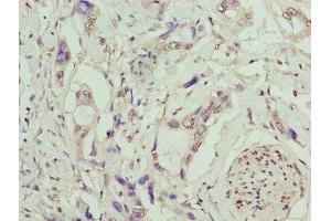 Immunohistochemistry of paraffin-embedded human pancreatic cancer using ABIN7173237 at dilution of 1:100 (TMEM53 抗体  (AA 1-170))
