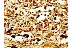 Immunohistochemistry of paraffin-embedded human melanoma using ABIN7146085 at dilution of 1: 100 (CD27 抗体  (AA 229-312))