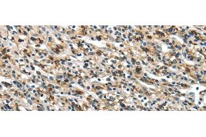 Immunohistochemistry of paraffin-embedded Human prostate cancer using GLP2R Polyclonal Antibody at dilution of 1/30 (GLP2R 抗体)