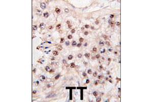 Formalin-fixed and paraffin-embedded human testicle tumor tissue reacted with HDAC11 polyclonal antibody  , which was peroxidase-conjugated to the secondary antibody, followed by DAB staining. (HDAC11 抗体  (C-Term))