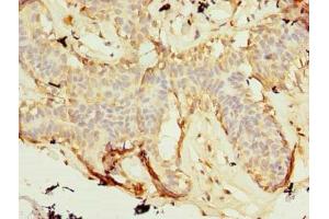 Immunohistochemistry of paraffin-embedded human breast cancer using ABIN7176140 at dilution of 1:100 (ZNF19 抗体  (AA 1-200))