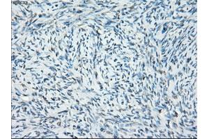 Immunohistochemical staining of paraffin-embedded Adenocarcinoma of breast tissue using anti-SSX2 mouse monoclonal antibody. (SSX2 抗体)