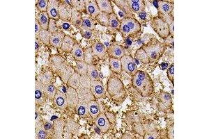 Immunohistochemical analysis of AP2-alpha-2 staining in human liver cancer formalin fixed paraffin embedded tissue section. (AP2A2 抗体)