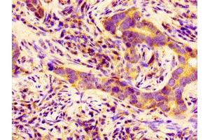 Immunohistochemistry of paraffin-embedded human pancreatic cancer using ABIN7145263 at dilution of 1:100 (BCAM 抗体  (AA 447-547))