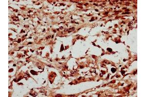 IHC image of ABIN7150959 diluted at 1:600 and staining in paraffin-embedded human melanoma performed on a Leica BondTM system.
