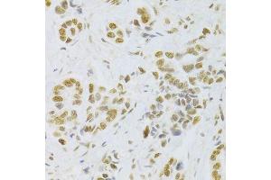 Immunohistochemistry of paraffin-embedded human breast cancer using HMGB1 Antibody. (HMGB1 抗体  (AA 100-200))