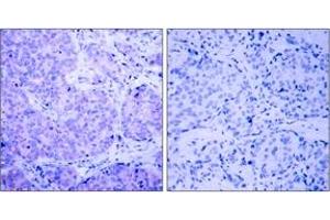 Immunohistochemistry (IHC) image for anti-3-phosphoinositide Dependent Protein Kinase-1 (PDPK1) (pSer241) antibody (ABIN2888512) (PDPK1 抗体  (pSer241))